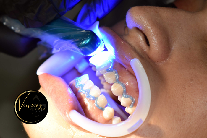 teeth whitening colombia