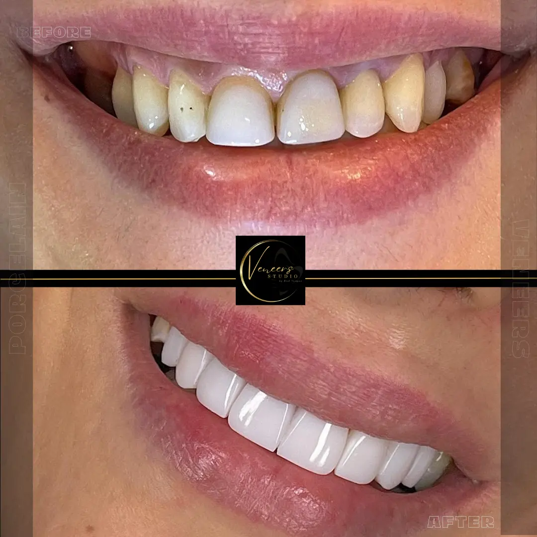 teeth done in colombia