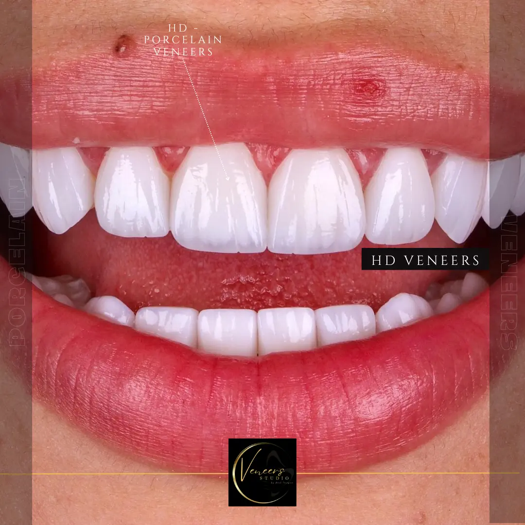 VENEERS STUDIO colombia REVIEWS hd veneers