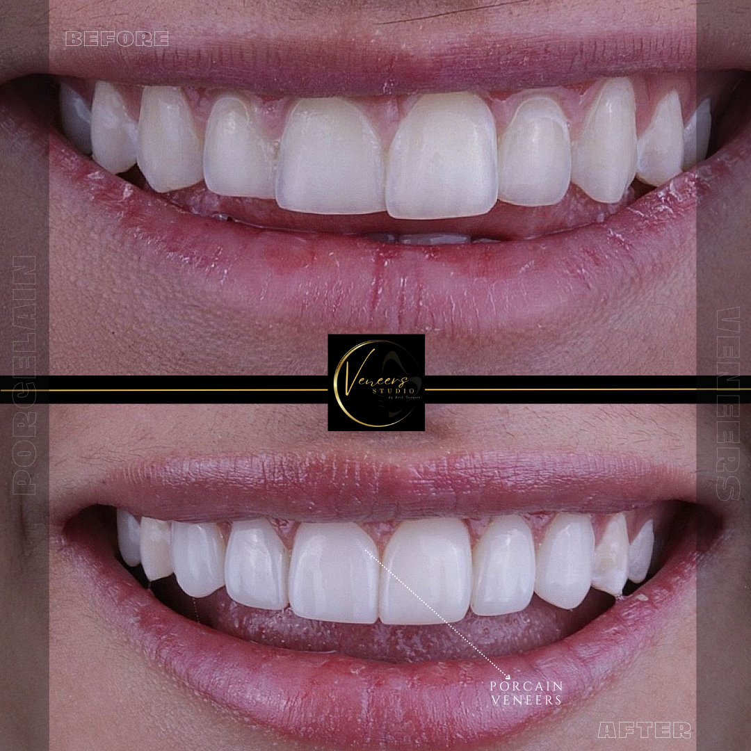 Porcelain veneers in colombia price