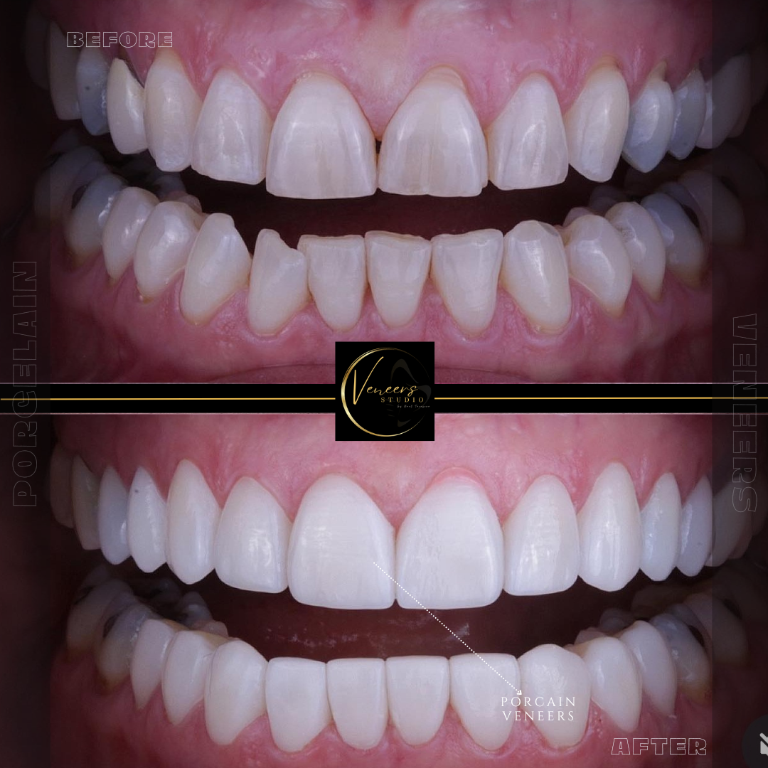 Getting veneers in colombia