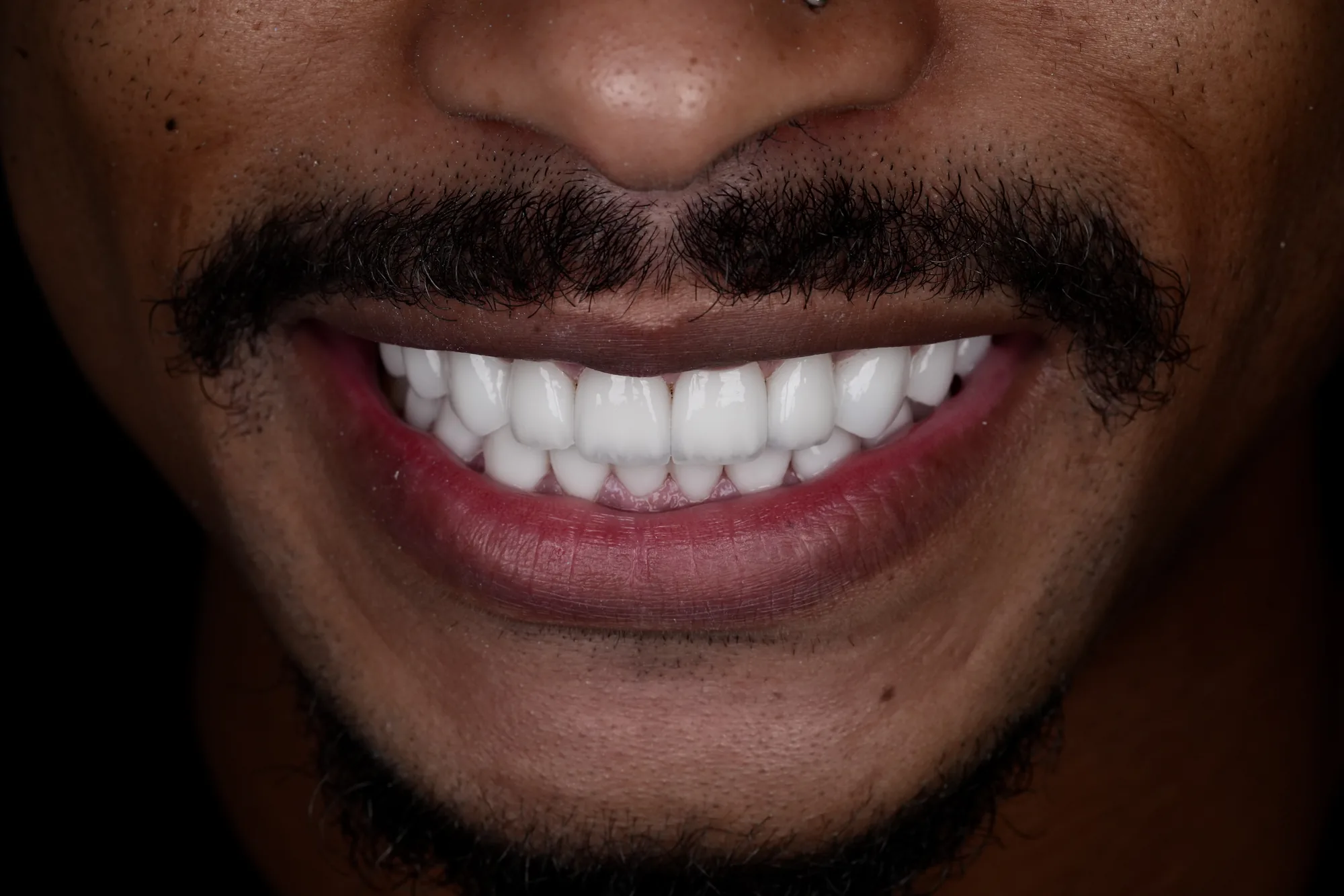 Smile after HD porcelain veneers in Medellin, Colombia – Veneers Studio Colombia