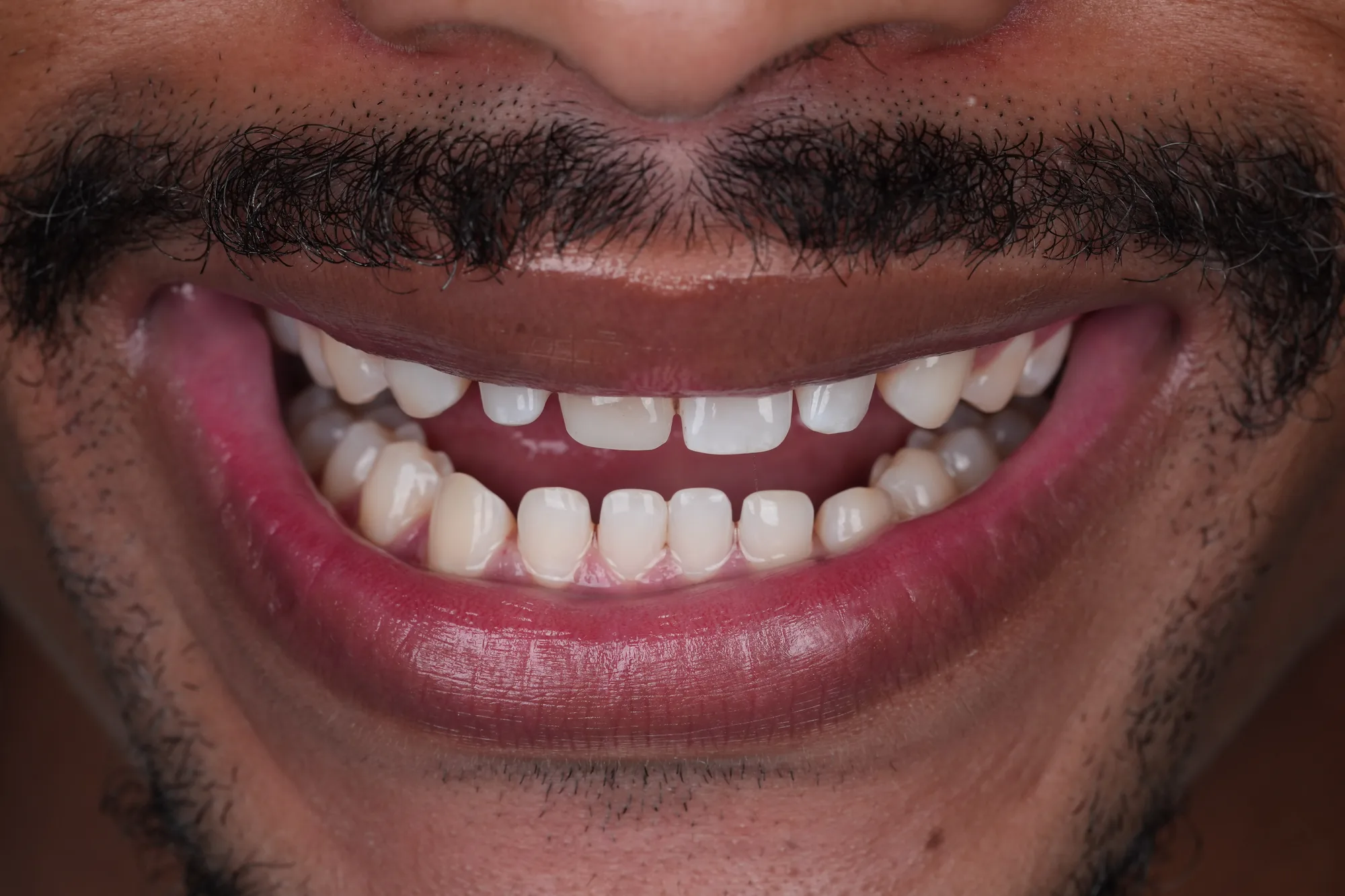 Smile before HD porcelain veneers in Colombia