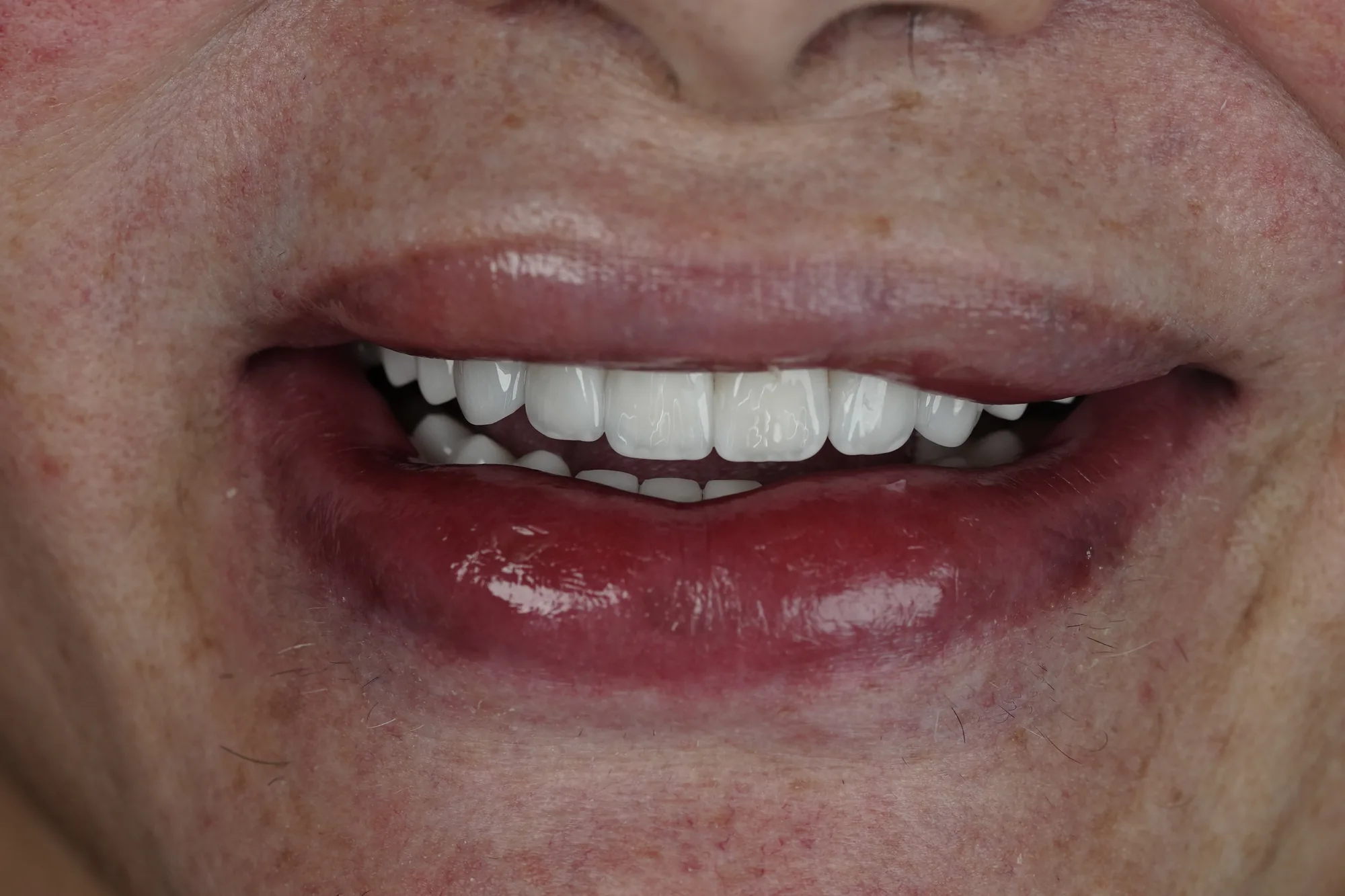 Smile after full oral rehabilitation in Medellin, Colombia – Veneers Studio Colombia