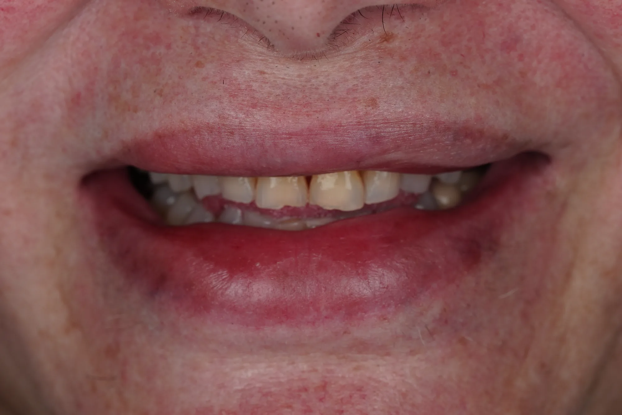 Smile before oral rehabilitation in Colombia