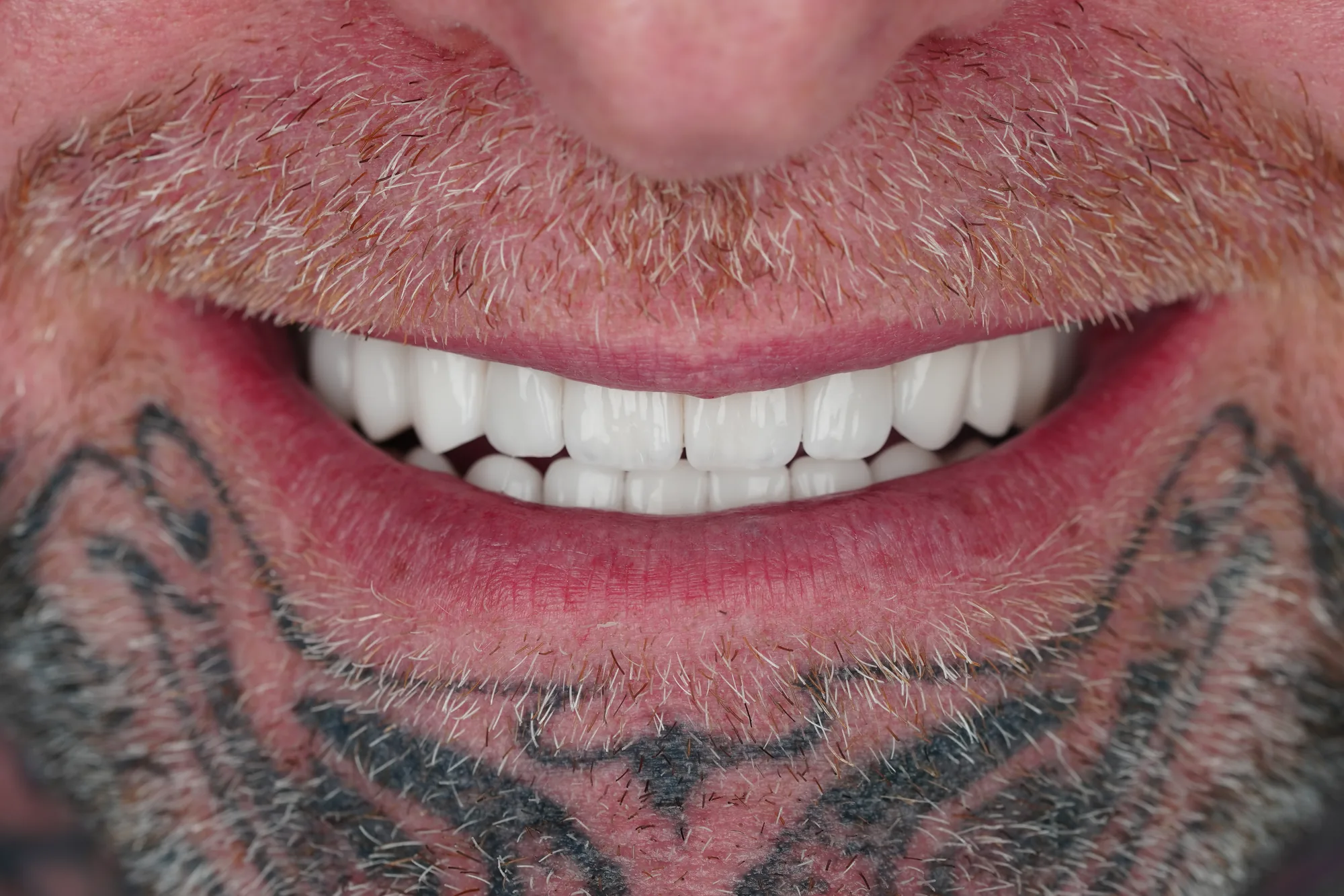 Male patient after porcelain veneers in Medellin, Colombia – Veneers Studio Colombia