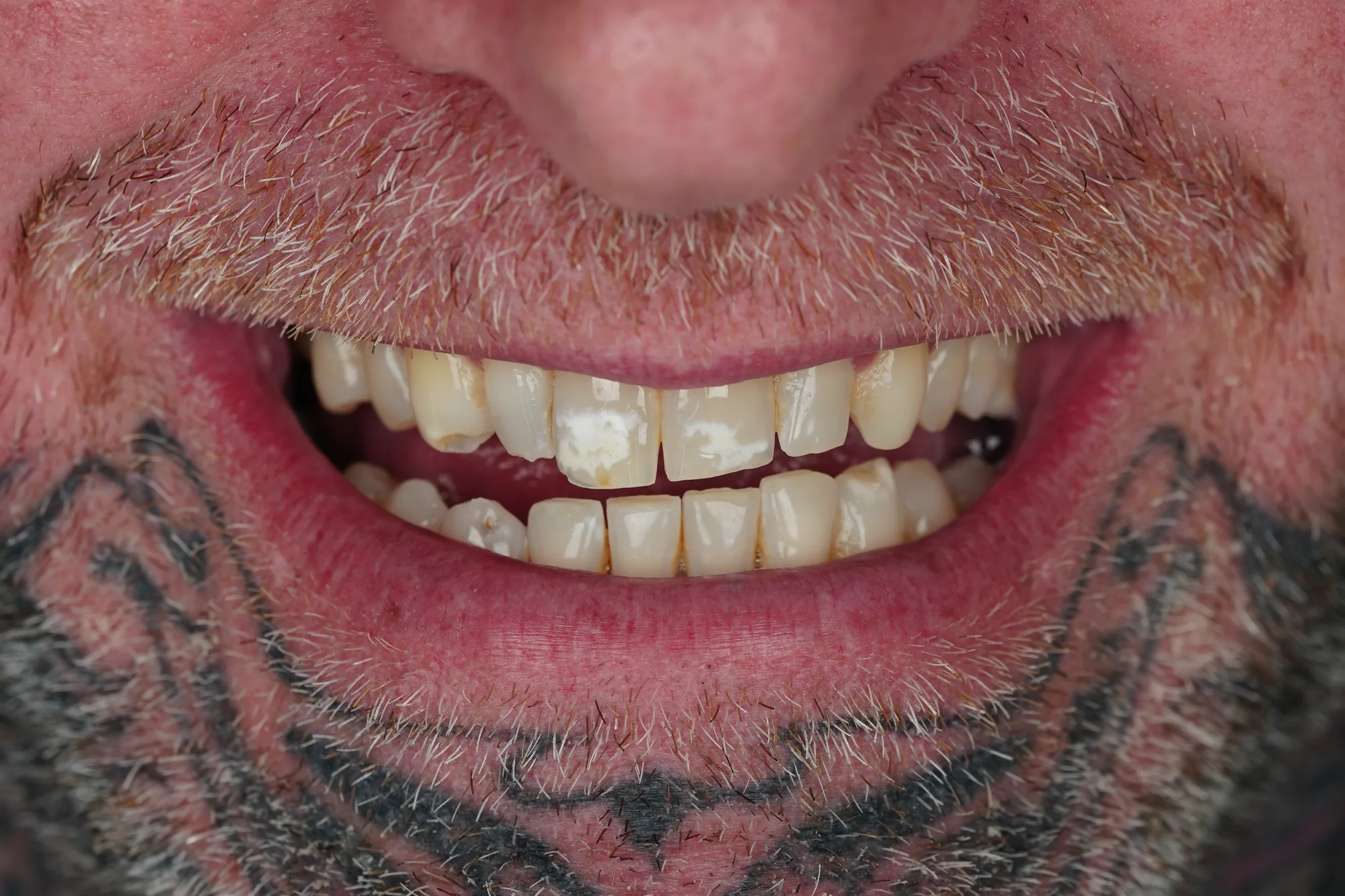 Male patient before porcelain veneers in Medellin, Colombia