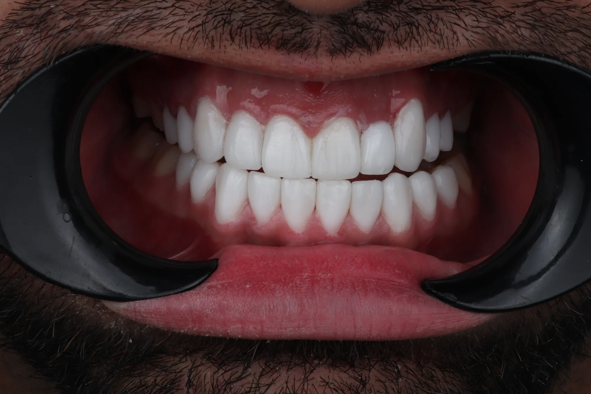 Digital smile design result with veneers in Medellin, Colombia – Veneers Studio Colombia