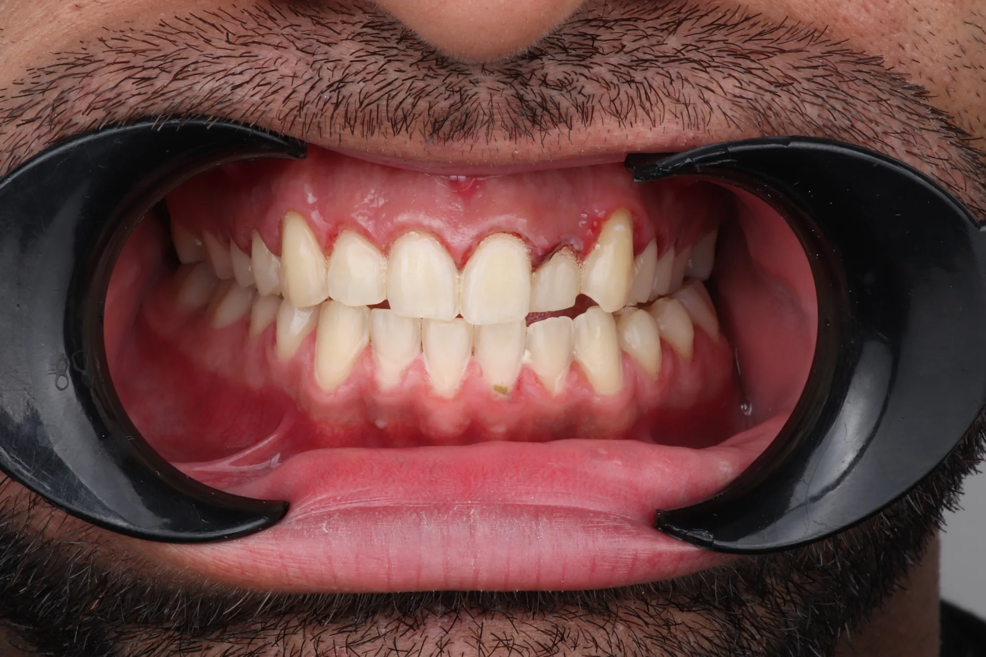 Teeth before digital smile design with veneers in Colombia