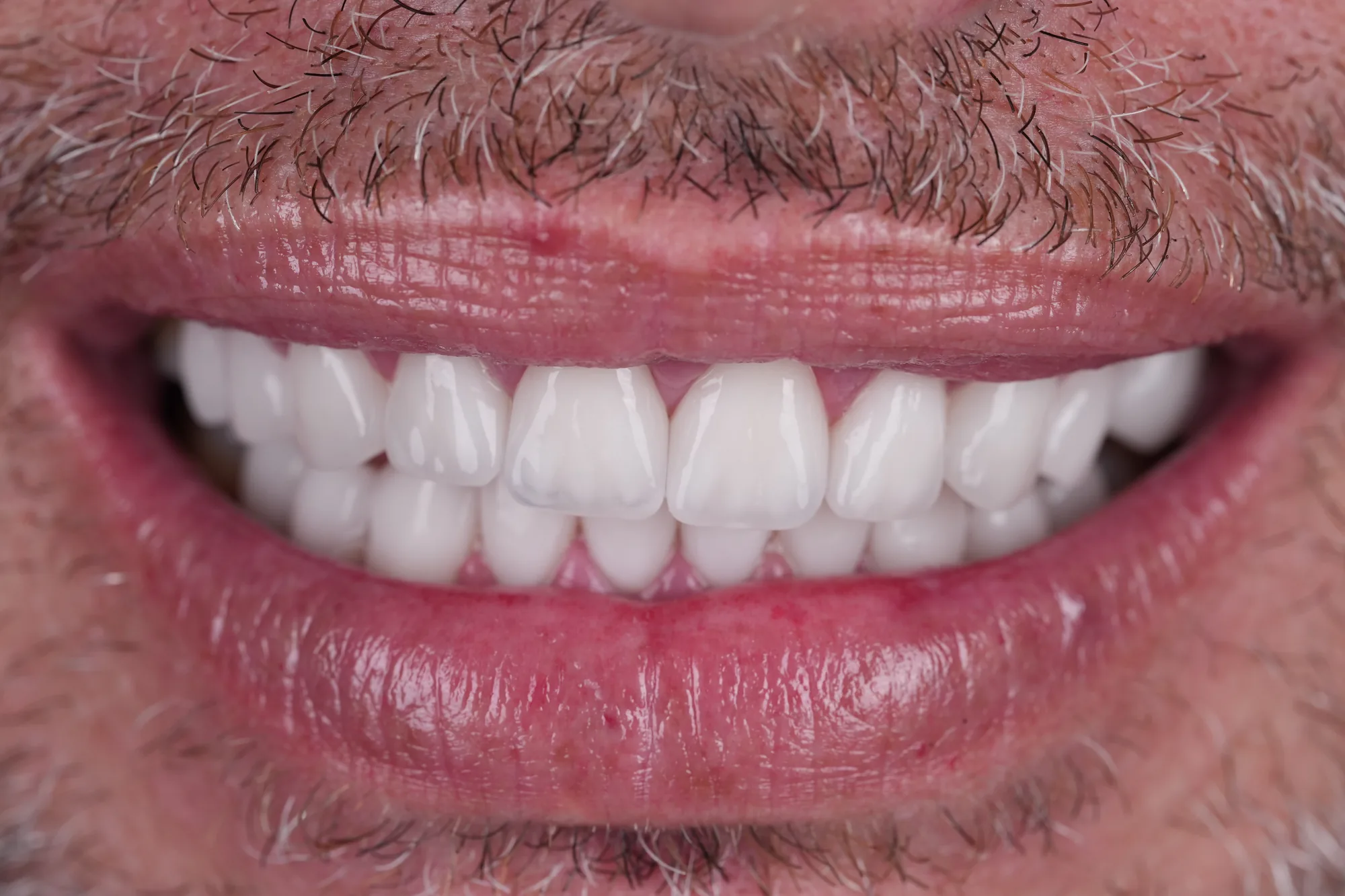 Smile makeover after porcelain veneers in Medellin, Colombia – Veneers Studio Colombia