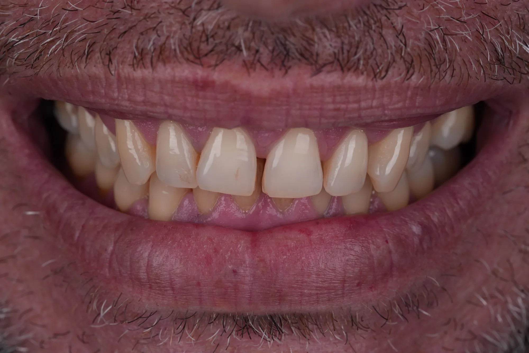 Smile before porcelain veneers smile makeover in Colombia