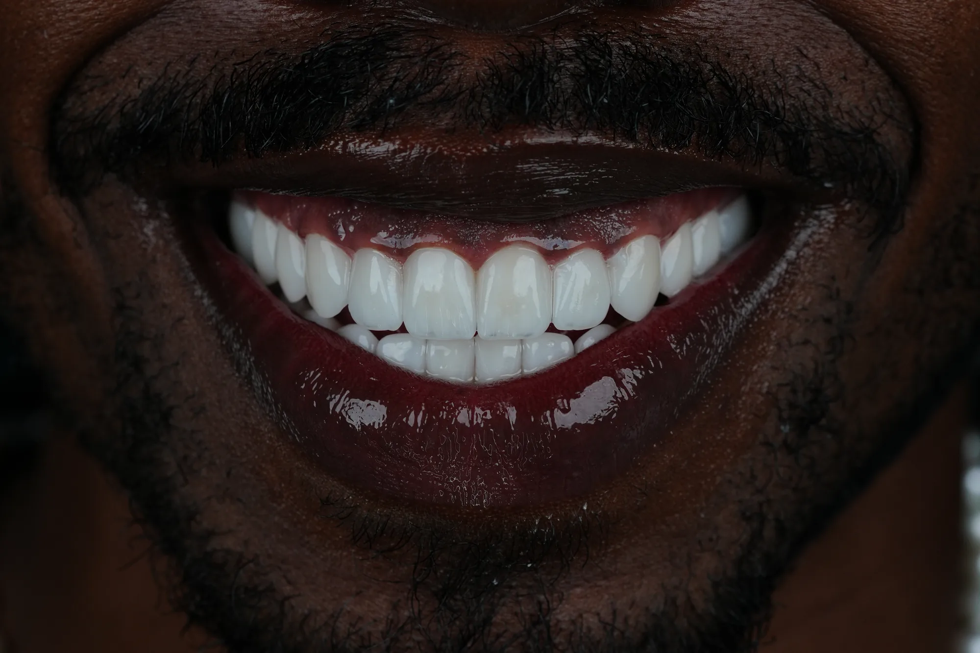 White, natural-looking teeth after veneers in Medellin, Colombia – Veneers Studio Colombia