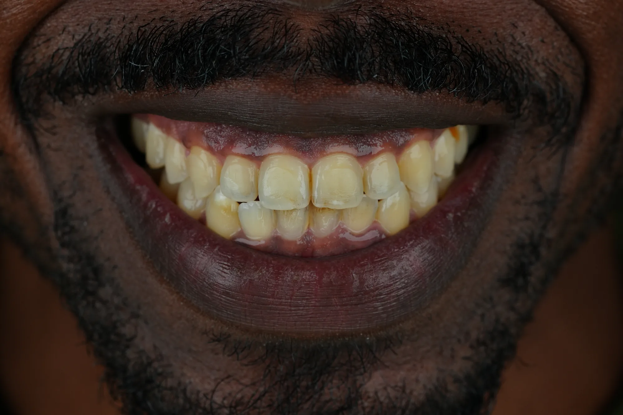 Patient's teeth before veneers in Colombia